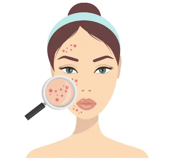Home made remedies on Acne Nutrixia Food